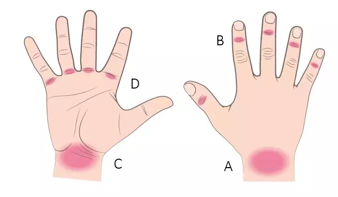 Ganglion på hand och fingrar