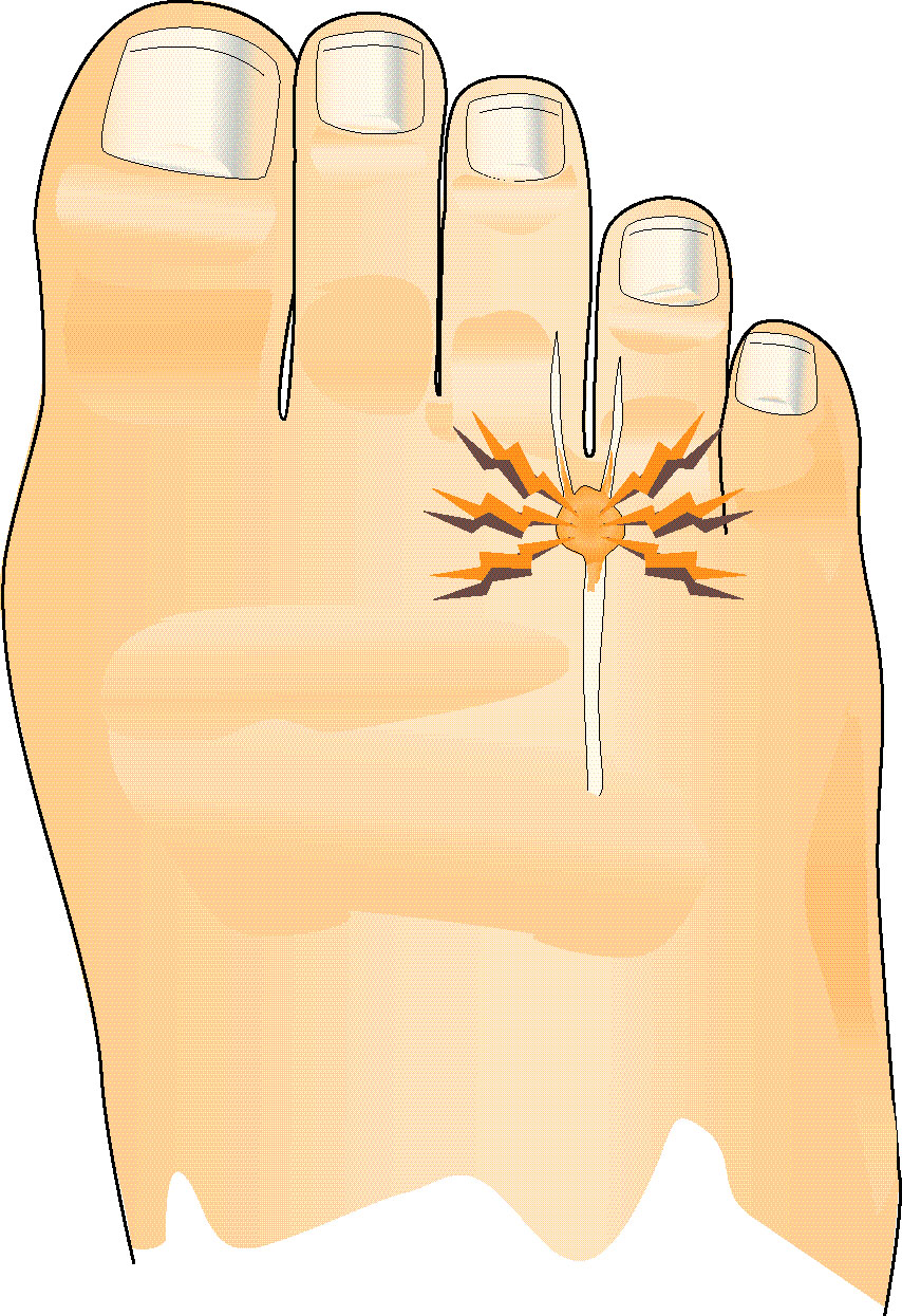 Illustration som visar att smärtan är vanligtvis lokaliserad mellan 3:e och 4:e tån.